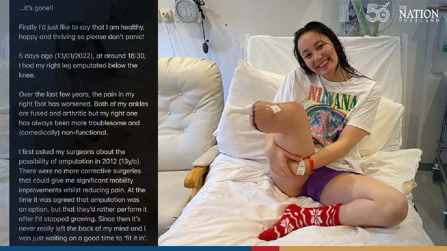Alice Tai has leg amputated below knee Alice Tai has leg amputated below knee