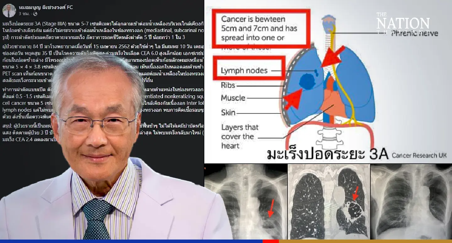 Going under the knife can save your life, says lung specialist Going under the knife can save your life, says lung specialist