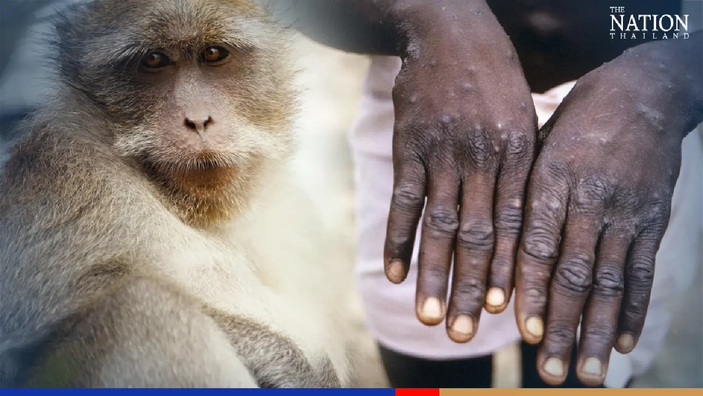 Smallpox jabs effective against monkeypox, says expert Smallpox jabs effective against monkeypox, says expert