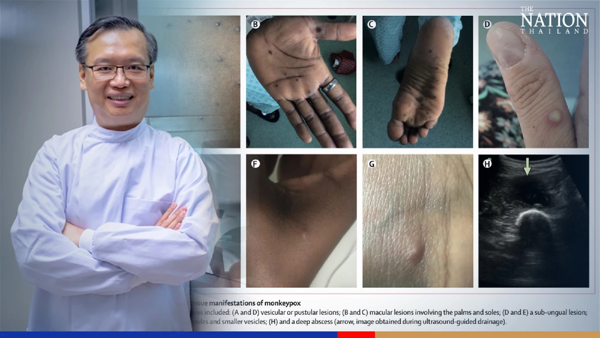 Virologist offers advice on keeping monkeypox at bay