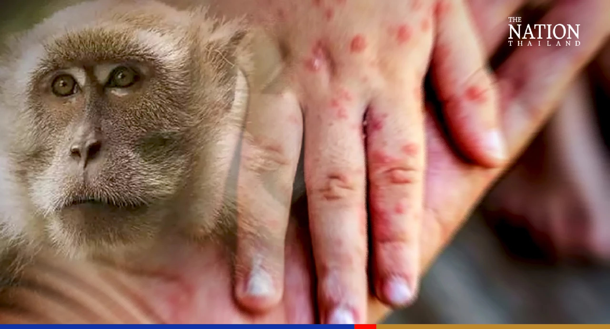 12 monitored after coming in contact with confirmed monkeypox patient
