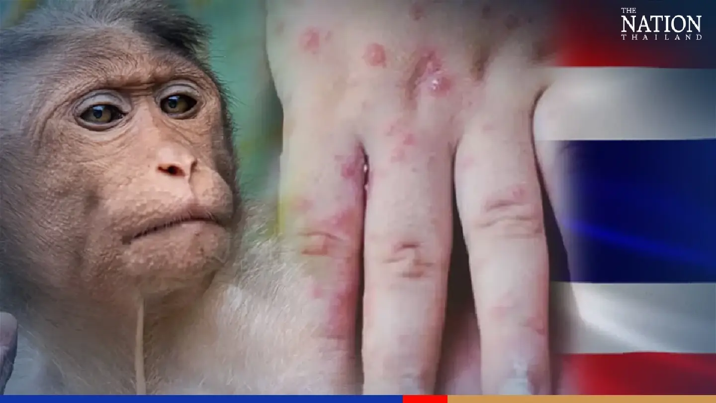 No monkeypox in Thailand so far but risk groups urged to self-monitor No monkeypox in Thailand so far but risk groups urged to self-monitor