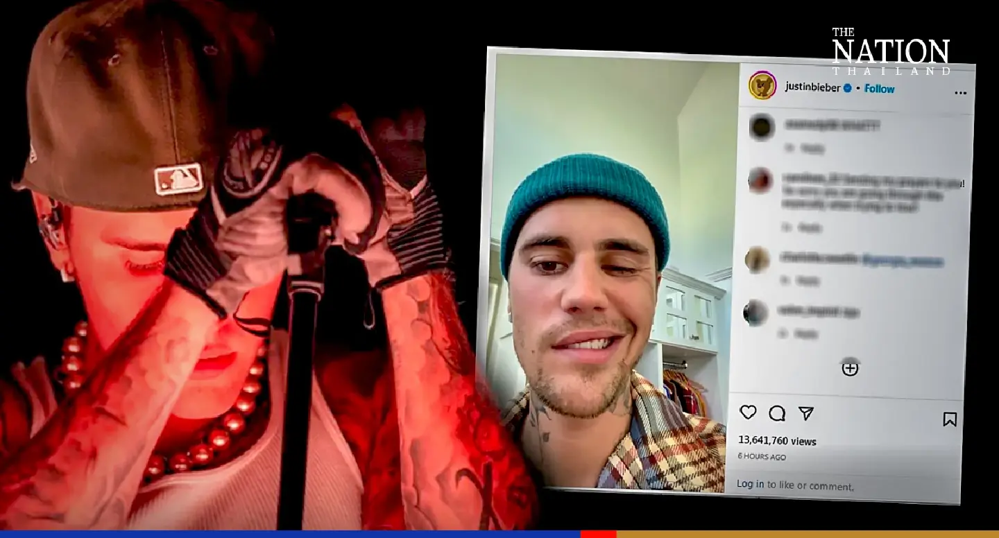 Justin Bieber suffers paralysed face due to rare viral condition