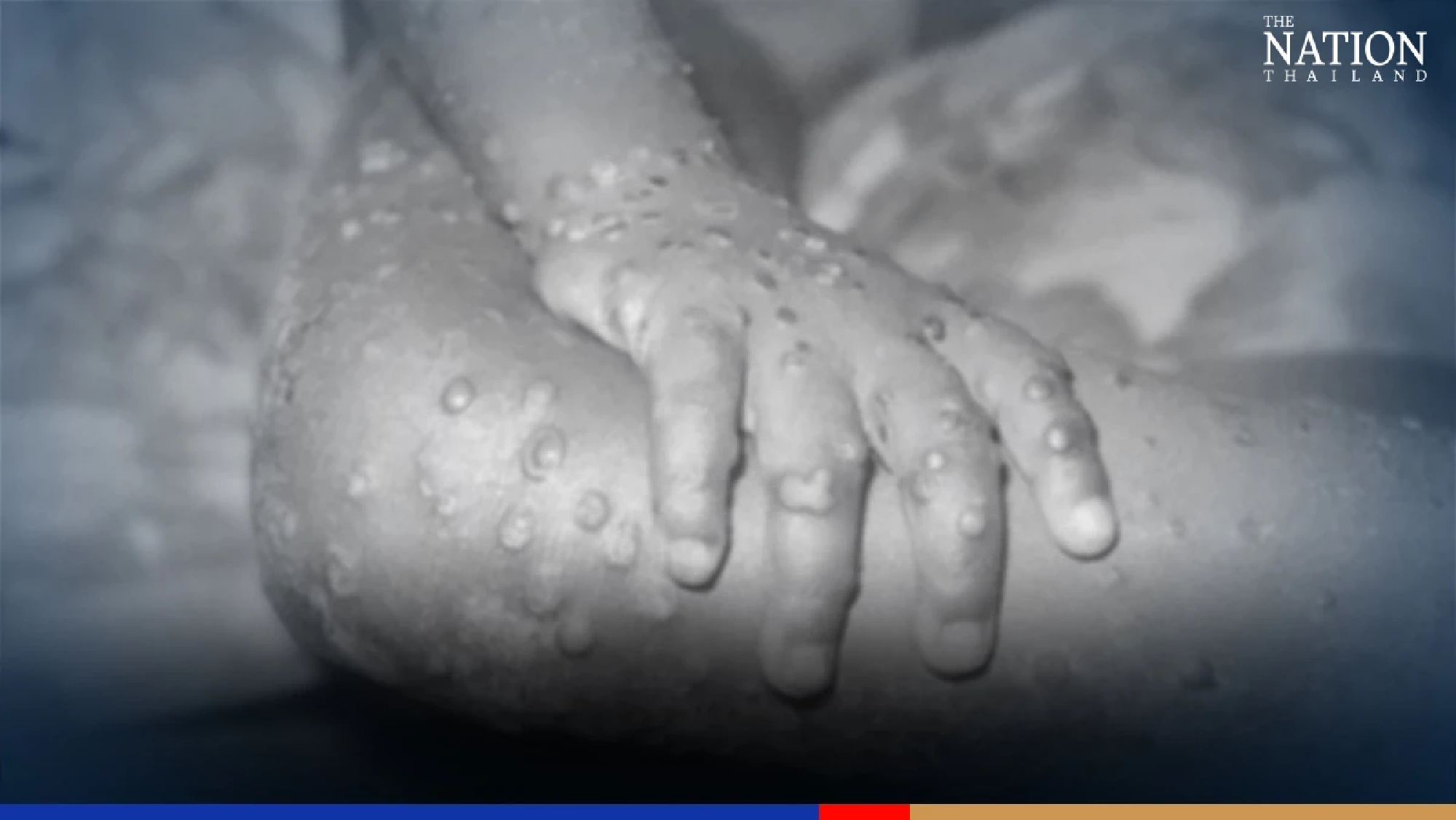 Thailand still free of monkey pox, all ten suspected cases dismissed