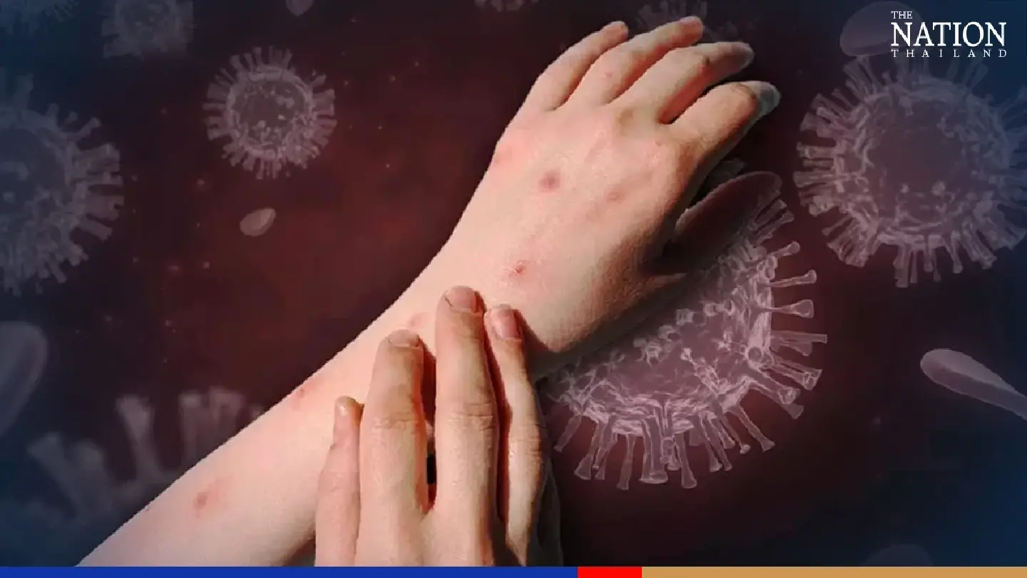 Health officials worried about monkeypox cases during Pride parade next week