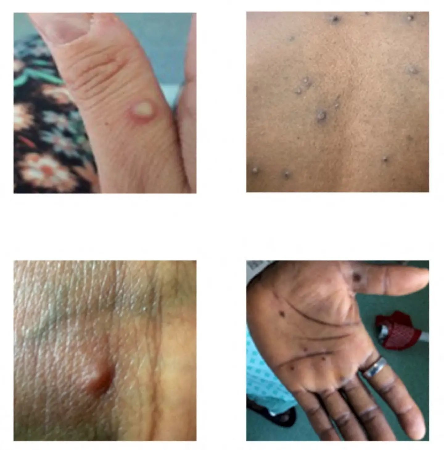 Indian capital reports first monkeypox case, bringing total to 4 Indian capital reports first monkeypox case, bringing total to 4