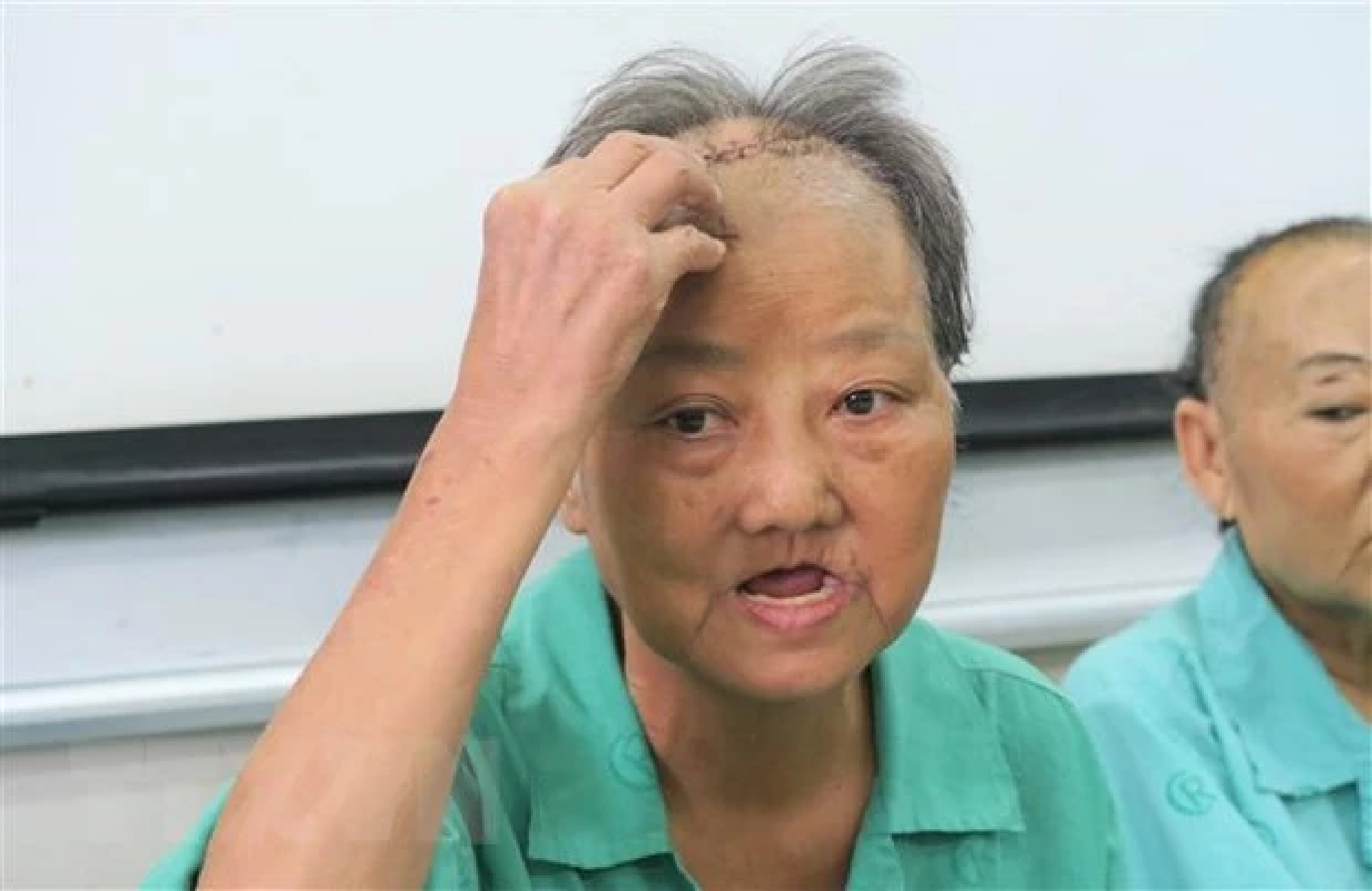 Doctors warn of post-Covid infections in skull, jaw and face