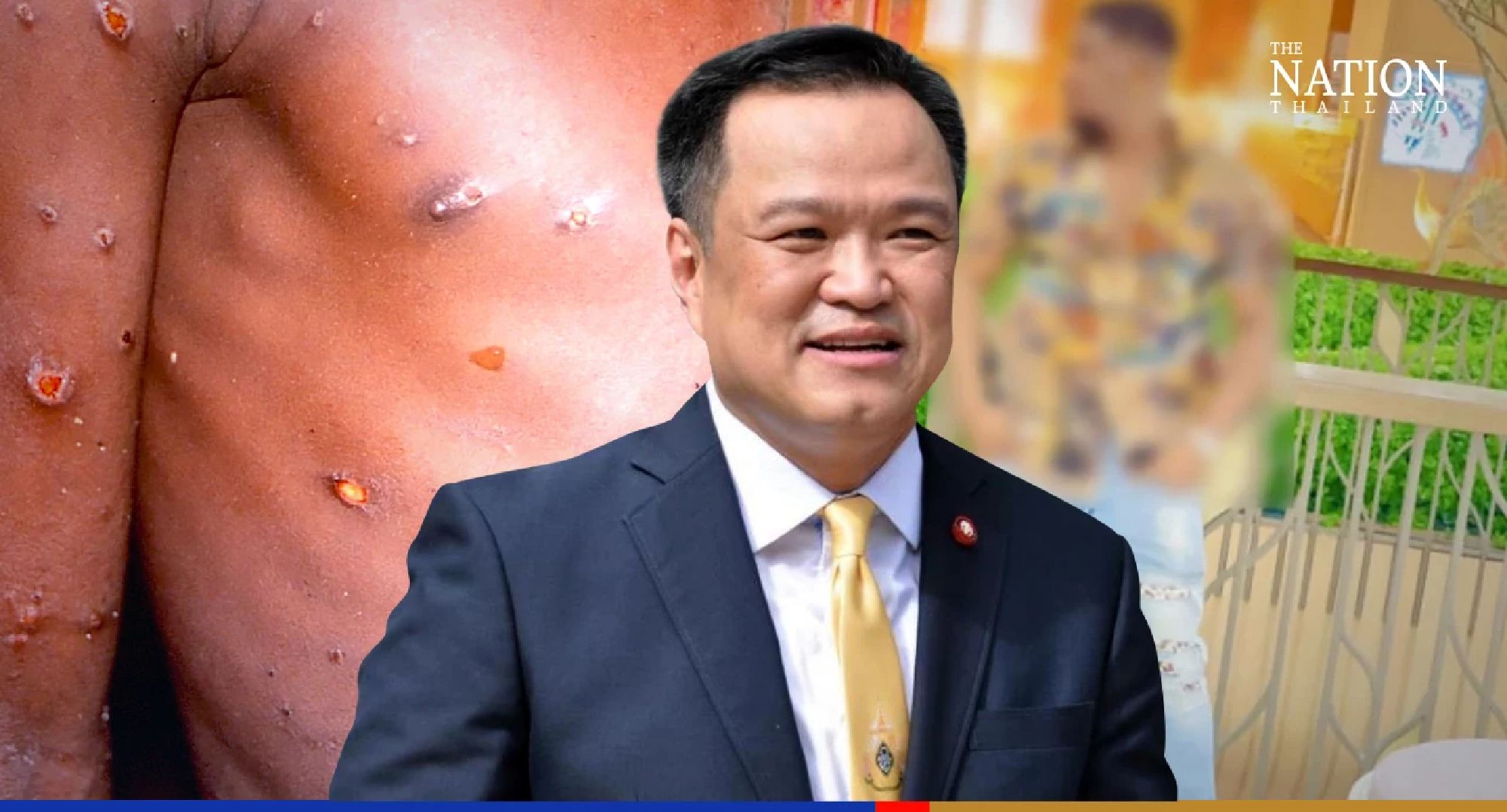 Missing Nigerian tourist diagnosed with monkeypox faces prosecution