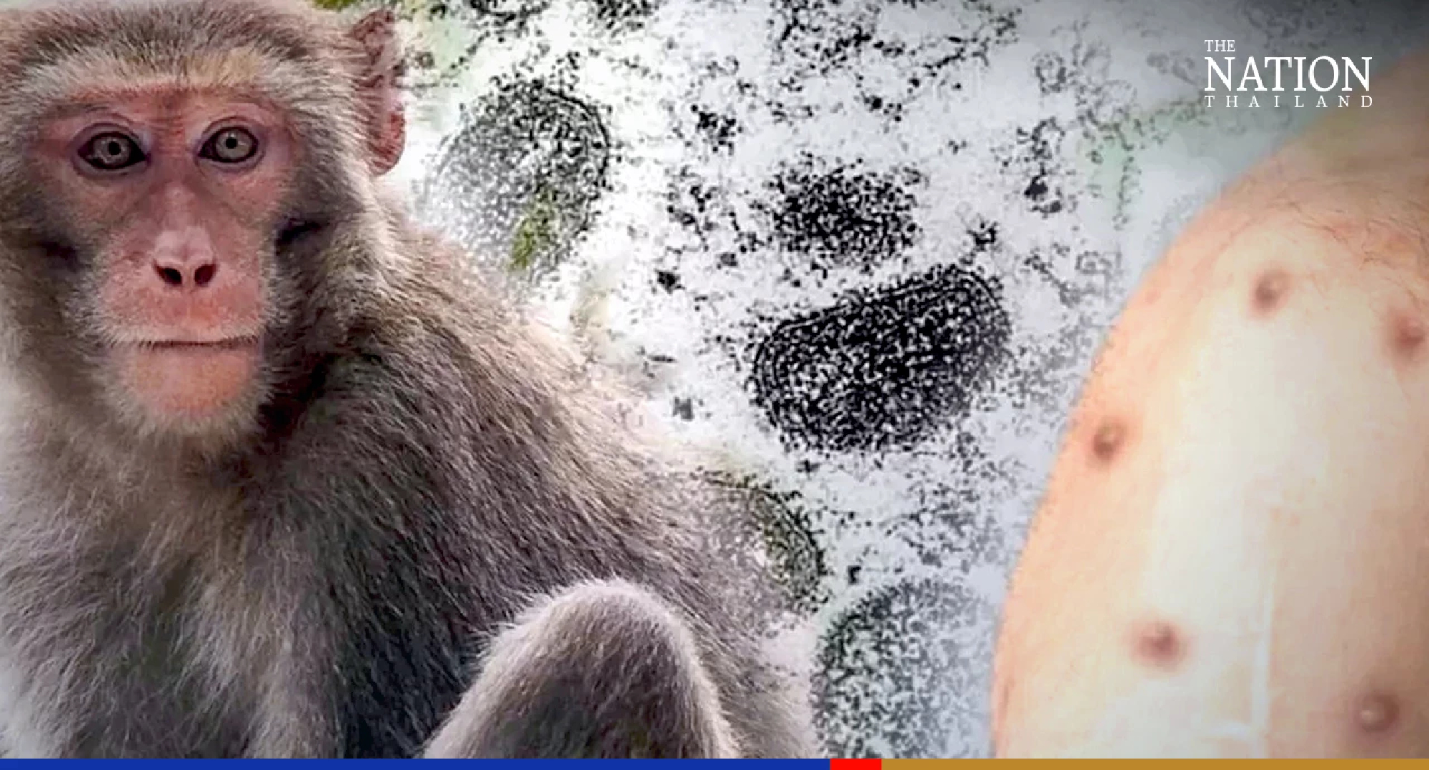 WHO seeks new name for monkeypox to prevent stigma, protect monkeys