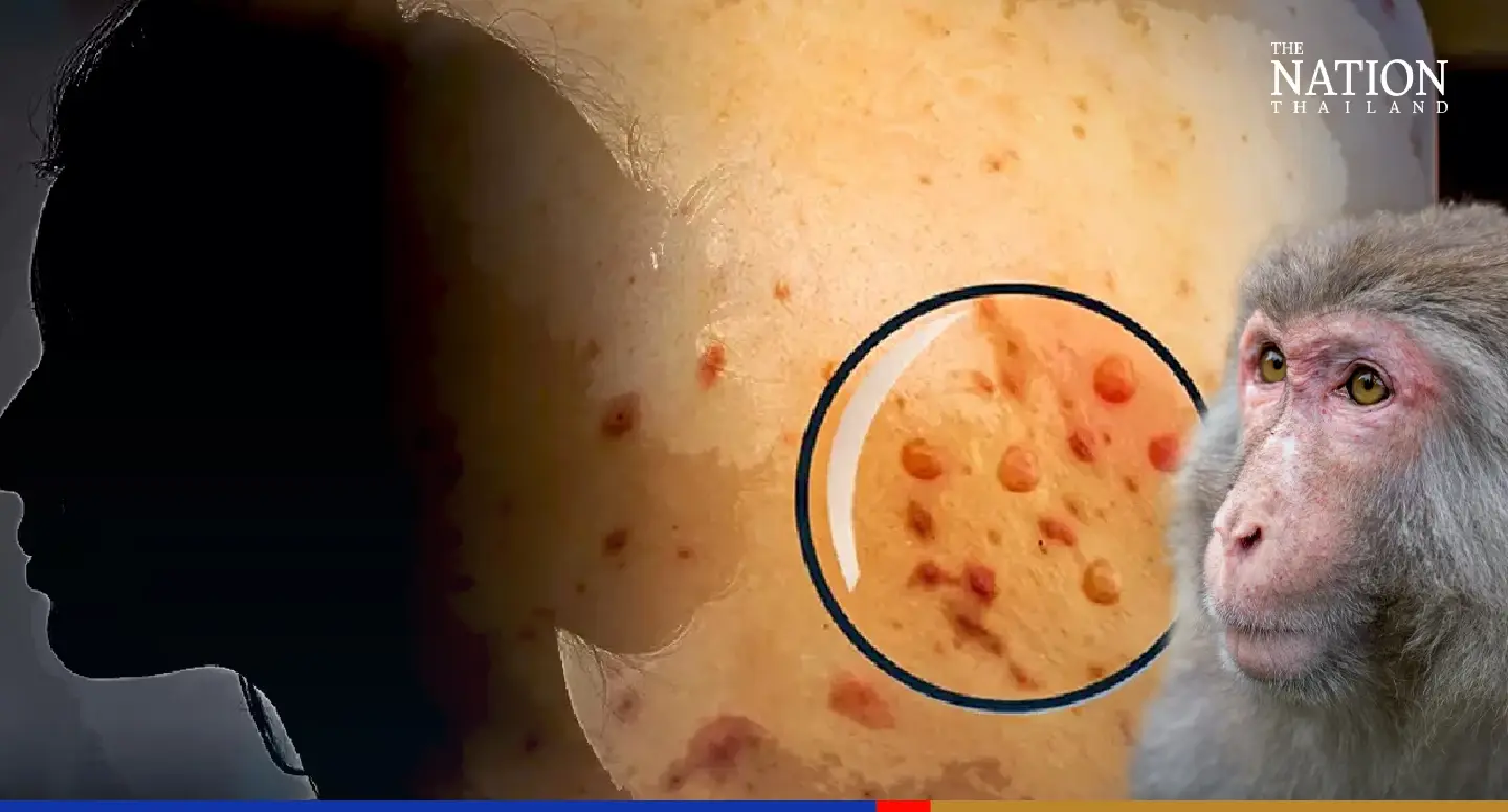 Bangkokian confirmed as Thailand’s 7th monkeypox case Bangkokian confirmed as Thailand’s 7th monkeypox case