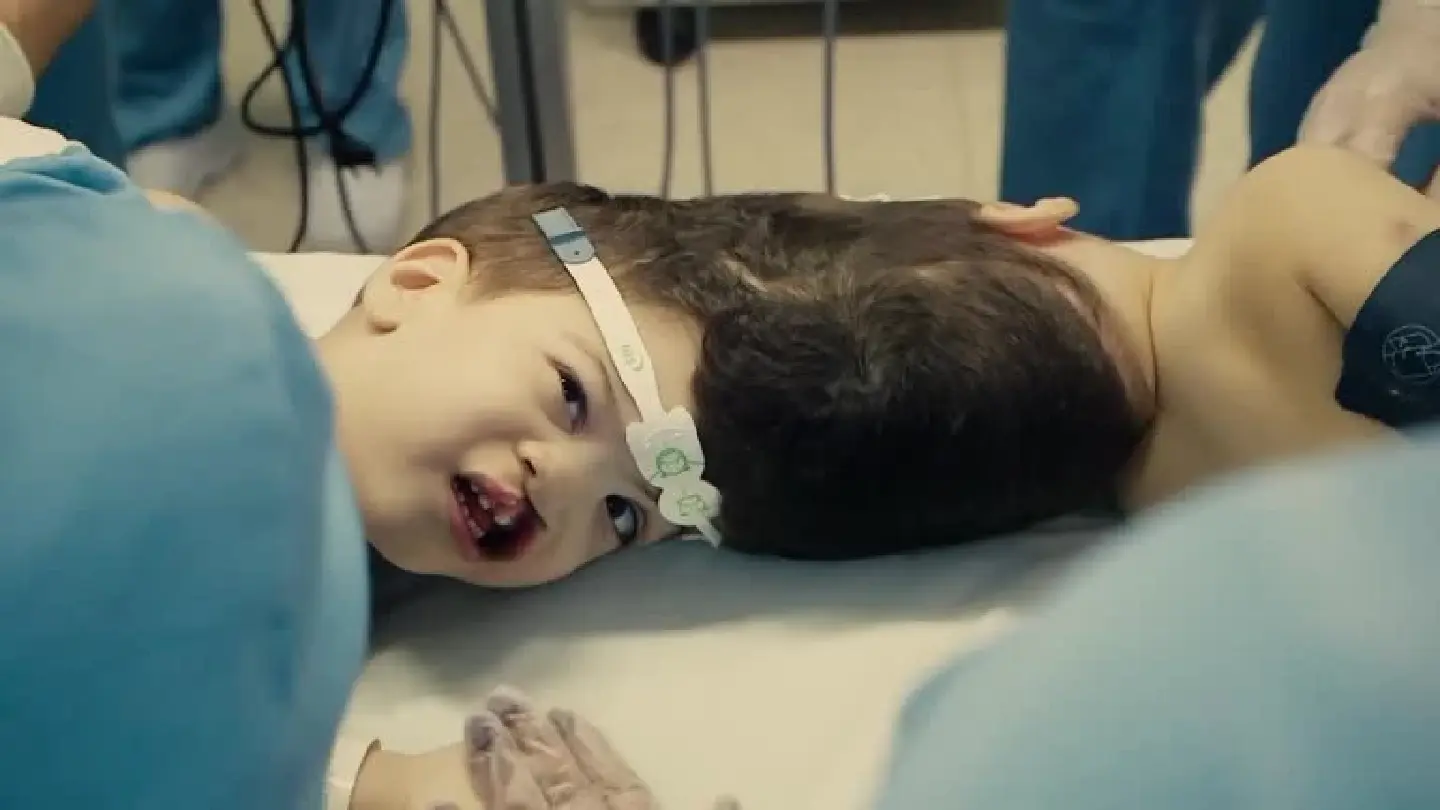 Brazilian doctors separate three-year-old conjoined twins Brazilian doctors separate three-year-old conjoined twins