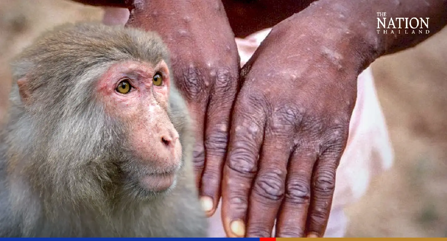 Vaccination helps reduce severity of monkeypox symptoms: study