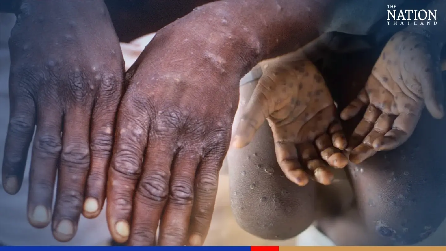 Want to kill monkeypox? 60 degrees could do the trick