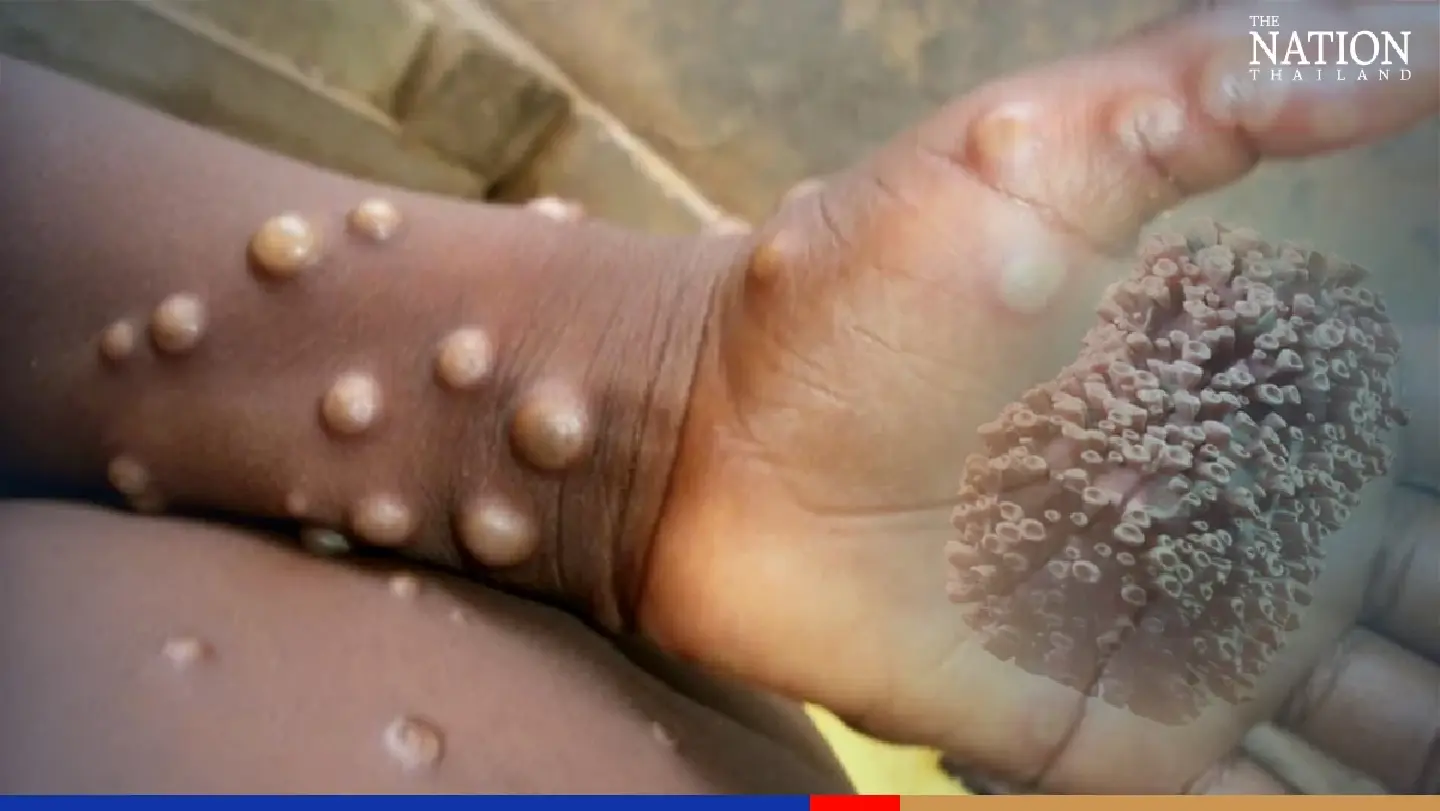 Thailand confirms first female monkeypox case Thailand confirms first female monkeypox case