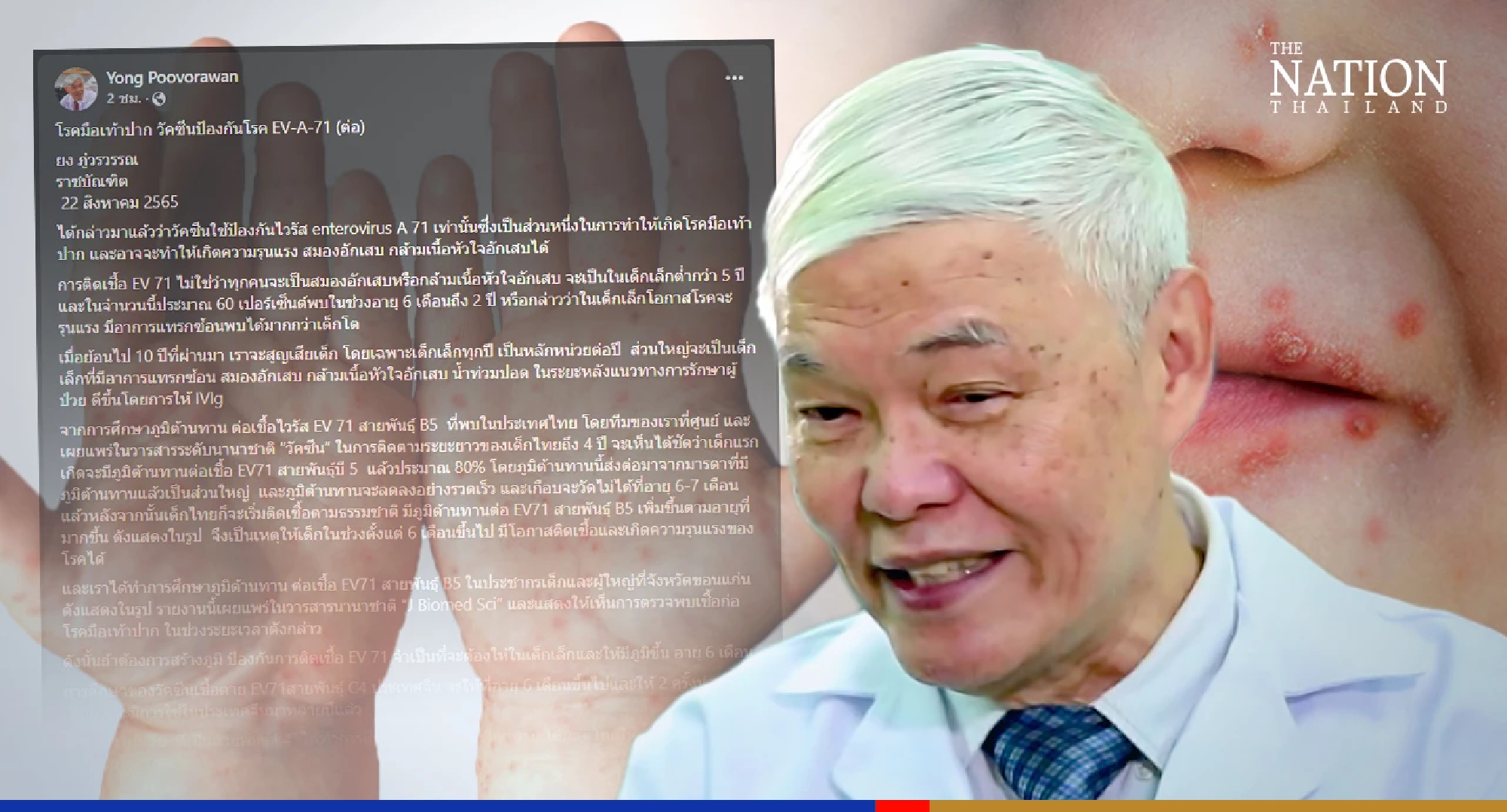 Toddlers aged 6 months to 2 years most at risk of complications from EV-A71 virus