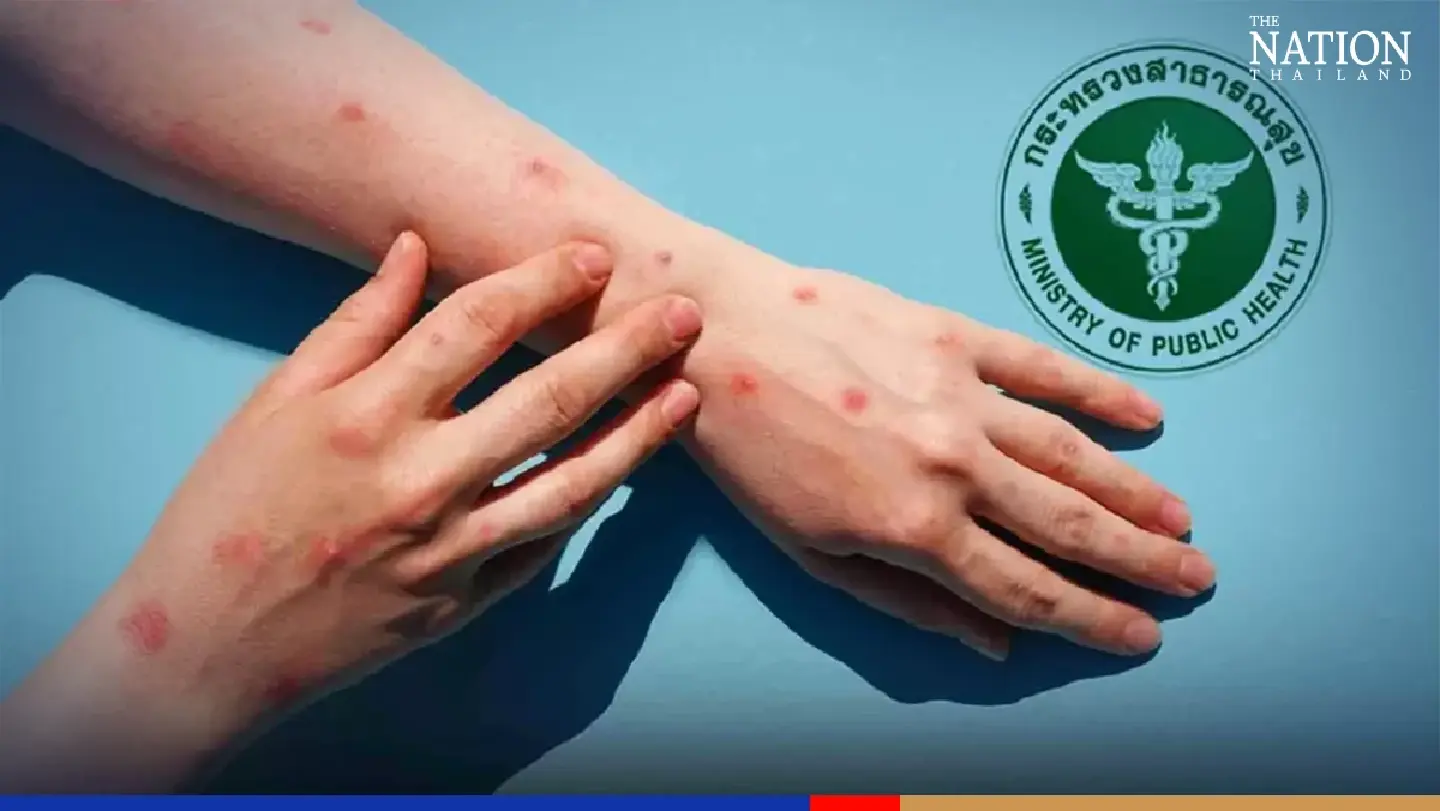 Those at risk of monkeypox and how to diagnose, treat the disease Those at risk of monkeypox and how to diagnose, treat the disease
