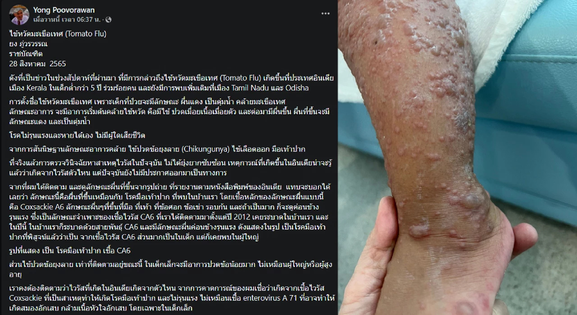 Virologist links ‘tomato flu’ to hand, foot, mouth disease virus