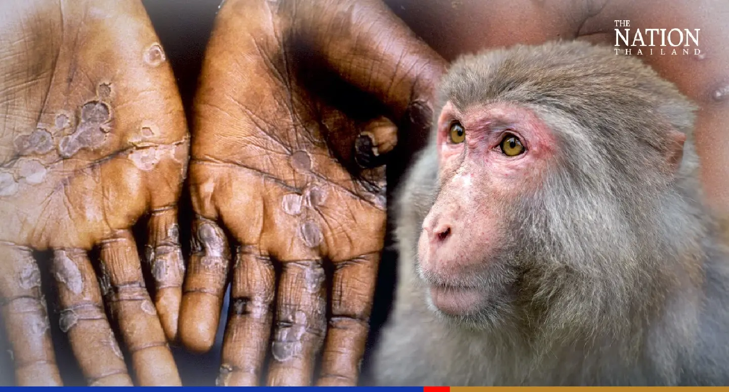 Ministry issues guidelines on treatment of monkeypox patients