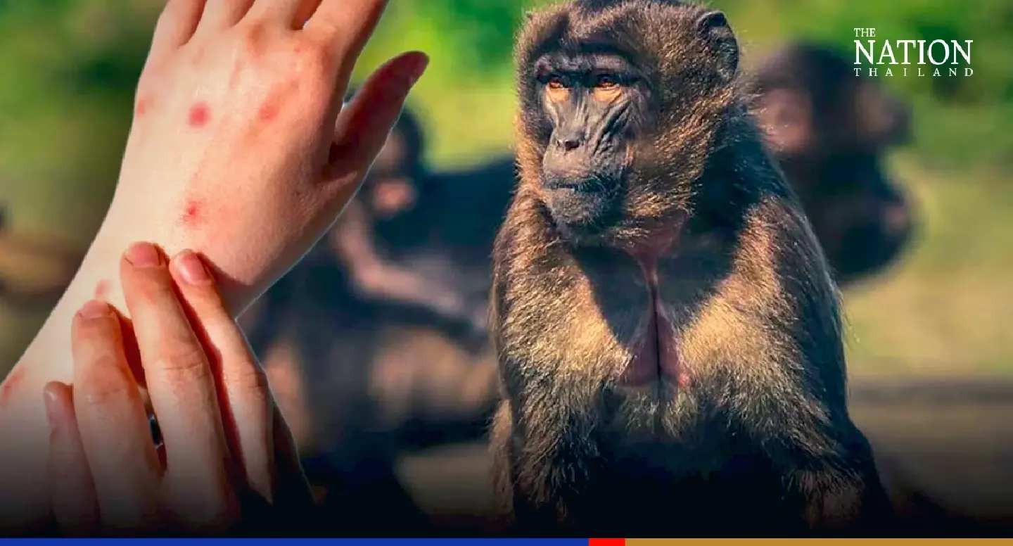 Thai man picks up monkeypox in Qatar, becomes 8th confirmed case Thai man picks up monkeypox in Qatar, becomes 8th confirmed case