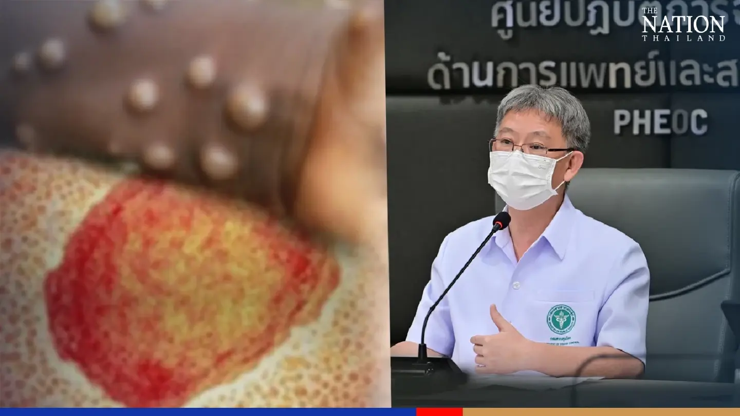 Phuket tourist and service worker test positive for monkeypox Phuket tourist and service worker test positive for monkeypox