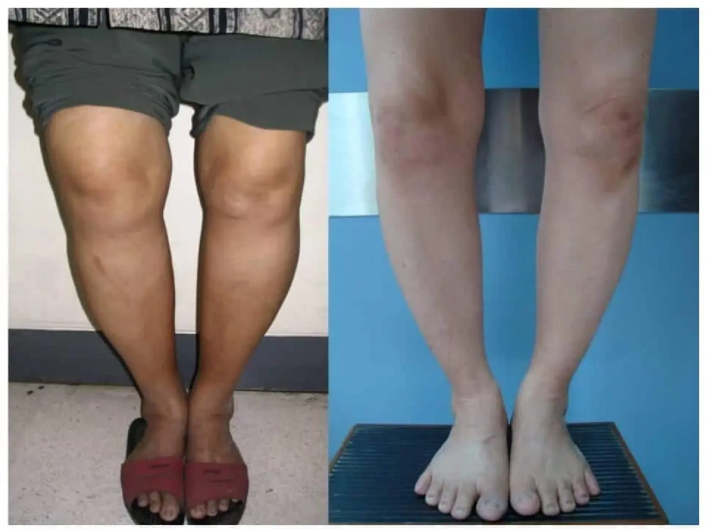 Chula Medicine Determines “Cytokines” as Indicator of “Degenerative Joints” 