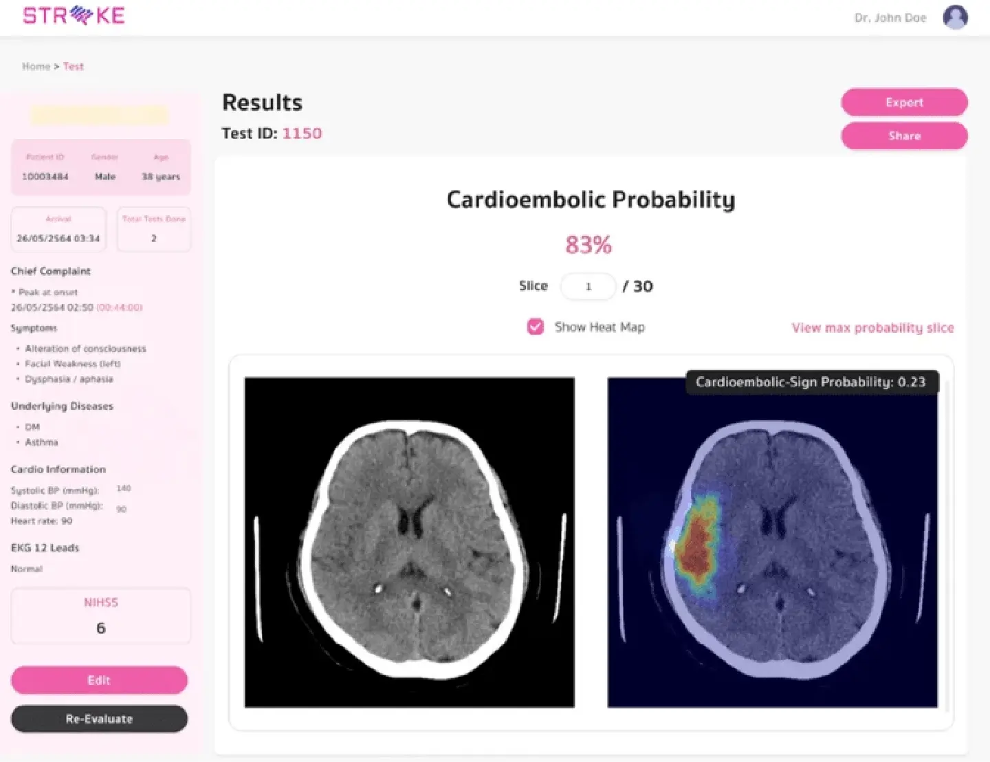 Chula’s AICute Innovation – An Assessment Tool for Ischemic Stroke Risk 