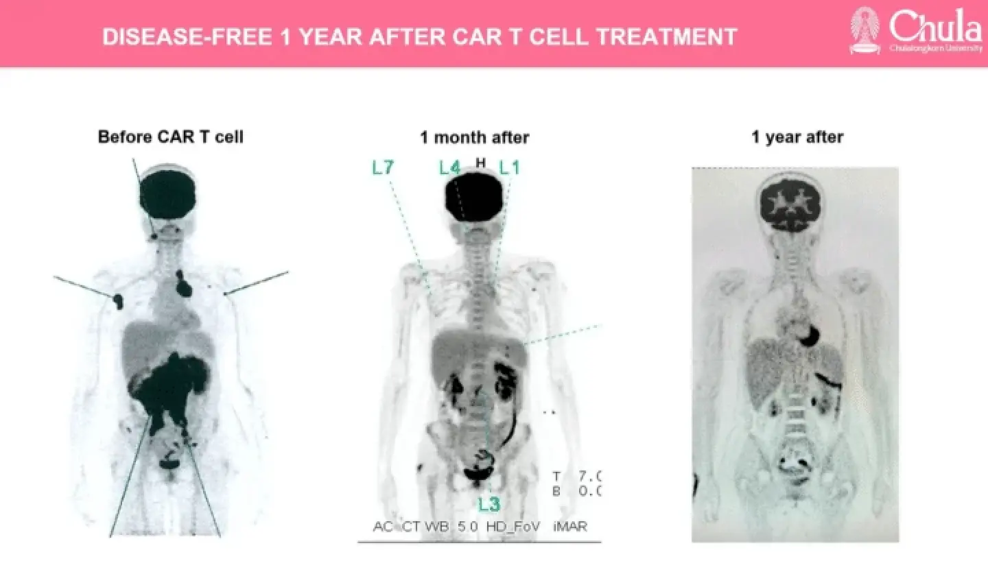 CAR T-Cell Therapy” Innovation:  New Hope for Thai Lymphoma Cancer Patients