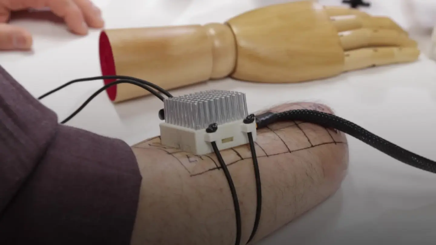 Bionic technology helps amputees feel warmth in phantom hands