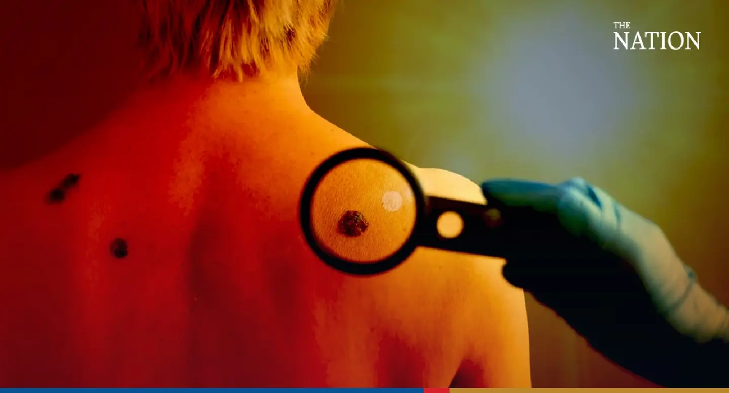 Global warming contributing to rise in skin cancer