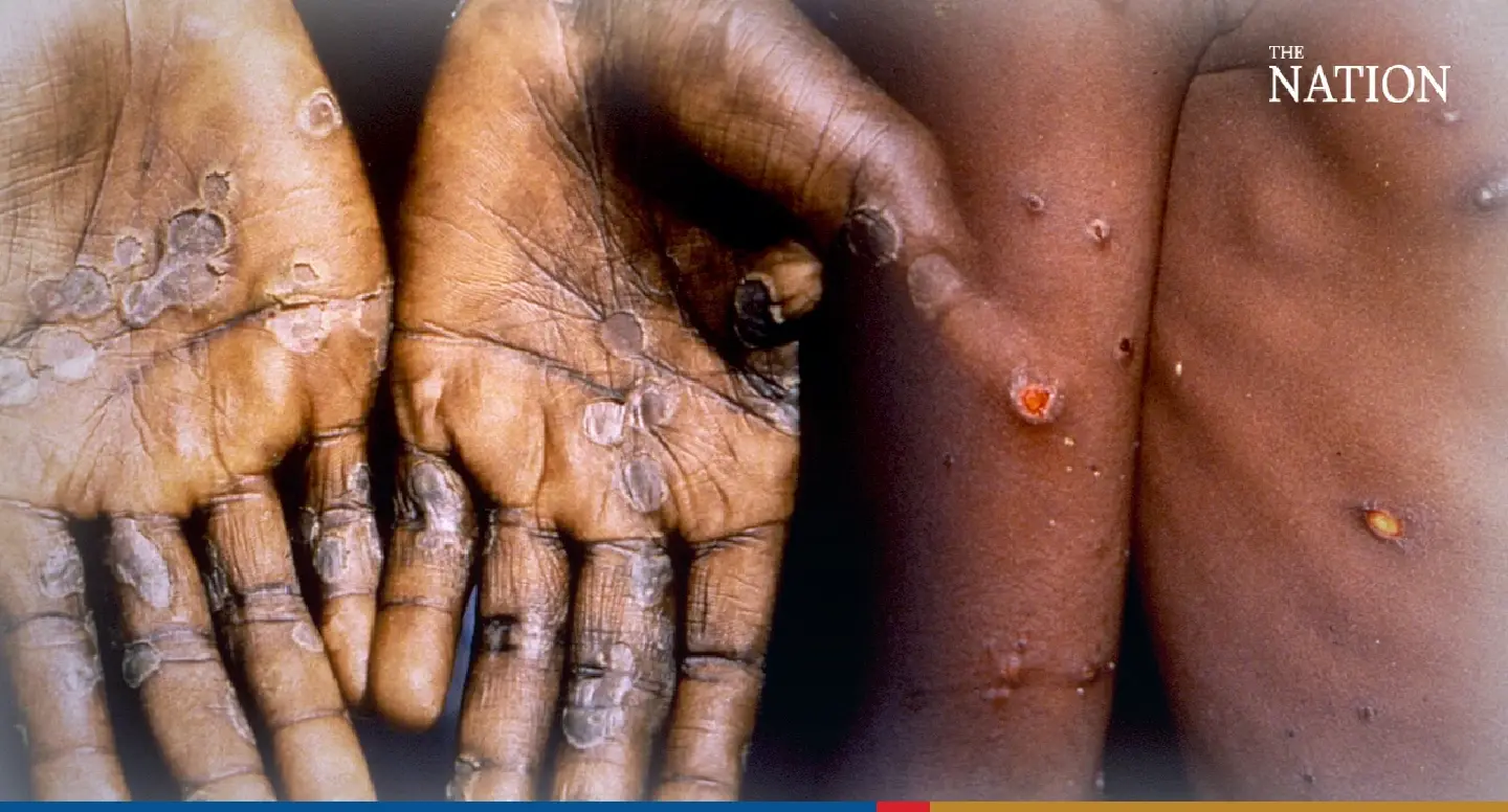 Rise in Monkeypox cases among young people: DDC