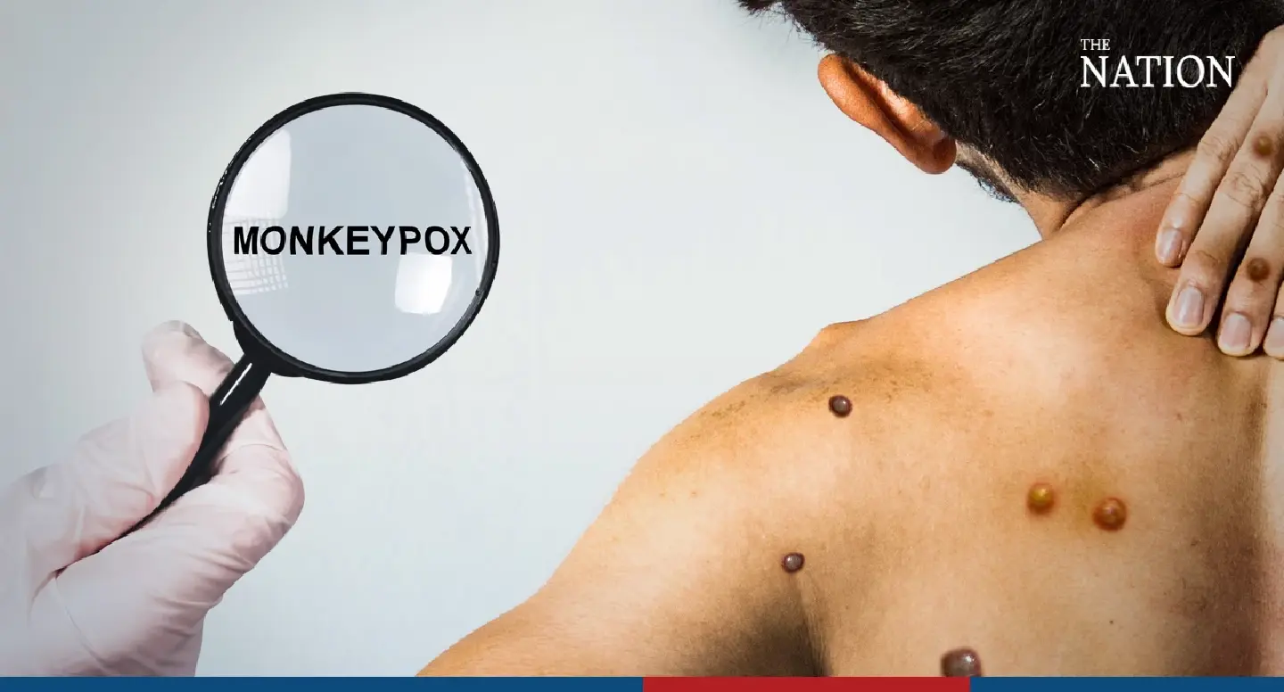Transmission of mpox virus on the rise in Thailand, says doctor