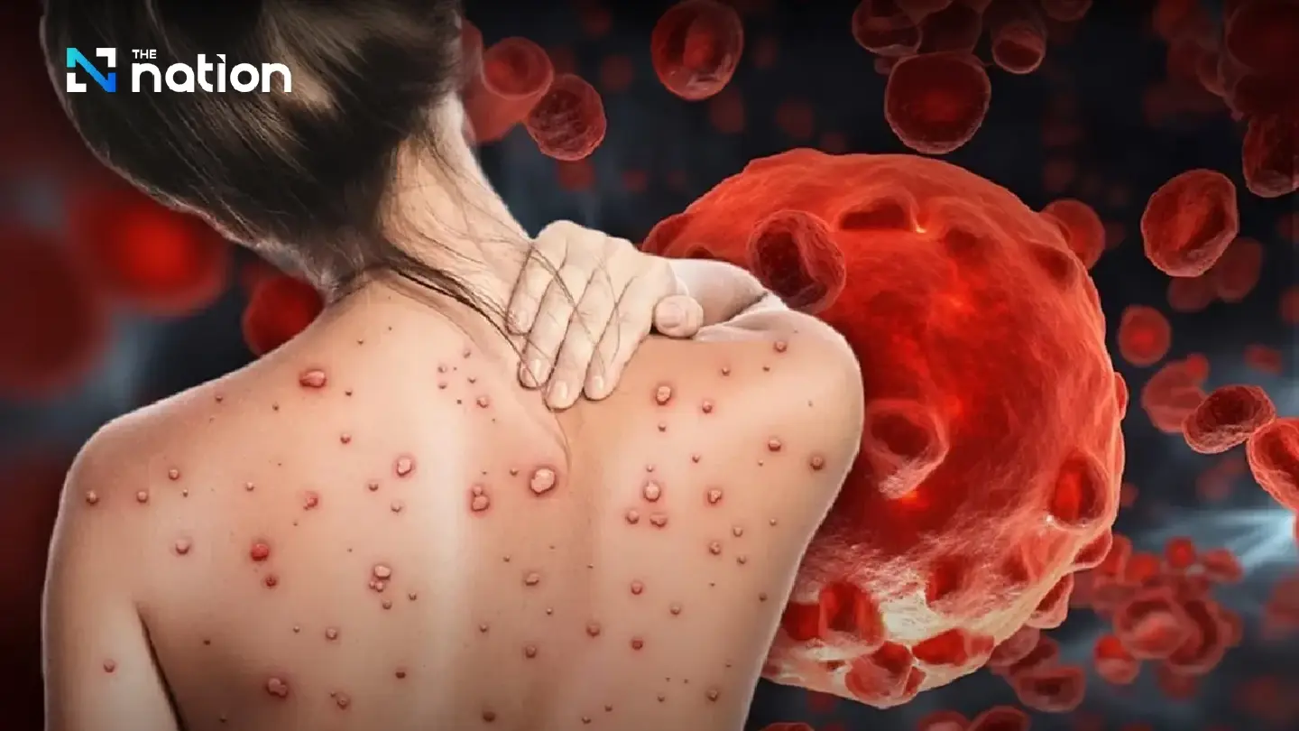 8 Mpox subvariants found in Thailand cause only mild disease