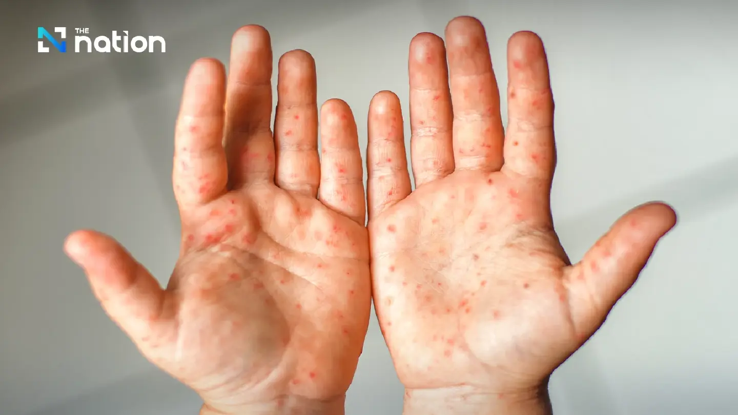 Low measles vaccination in 3 southern border provinces causes 5 deaths Low measles vaccination in 3 southern border provinces causes 5 deaths