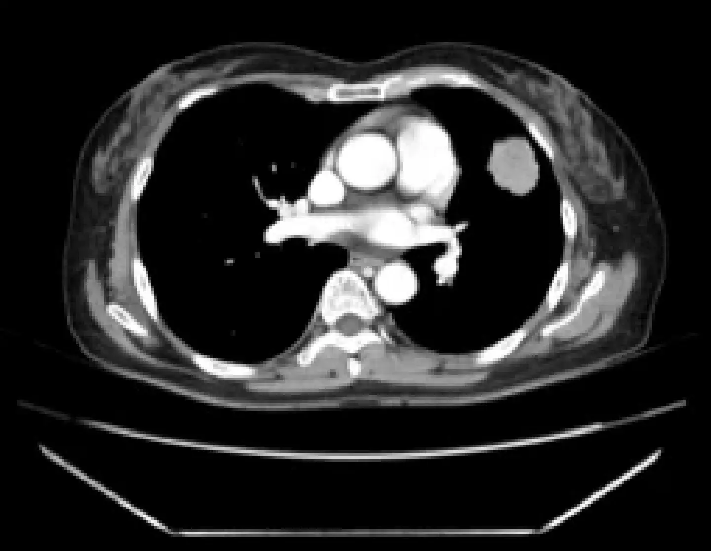 AI detects lung nodules linked to cancer 3 years before symptoms: study