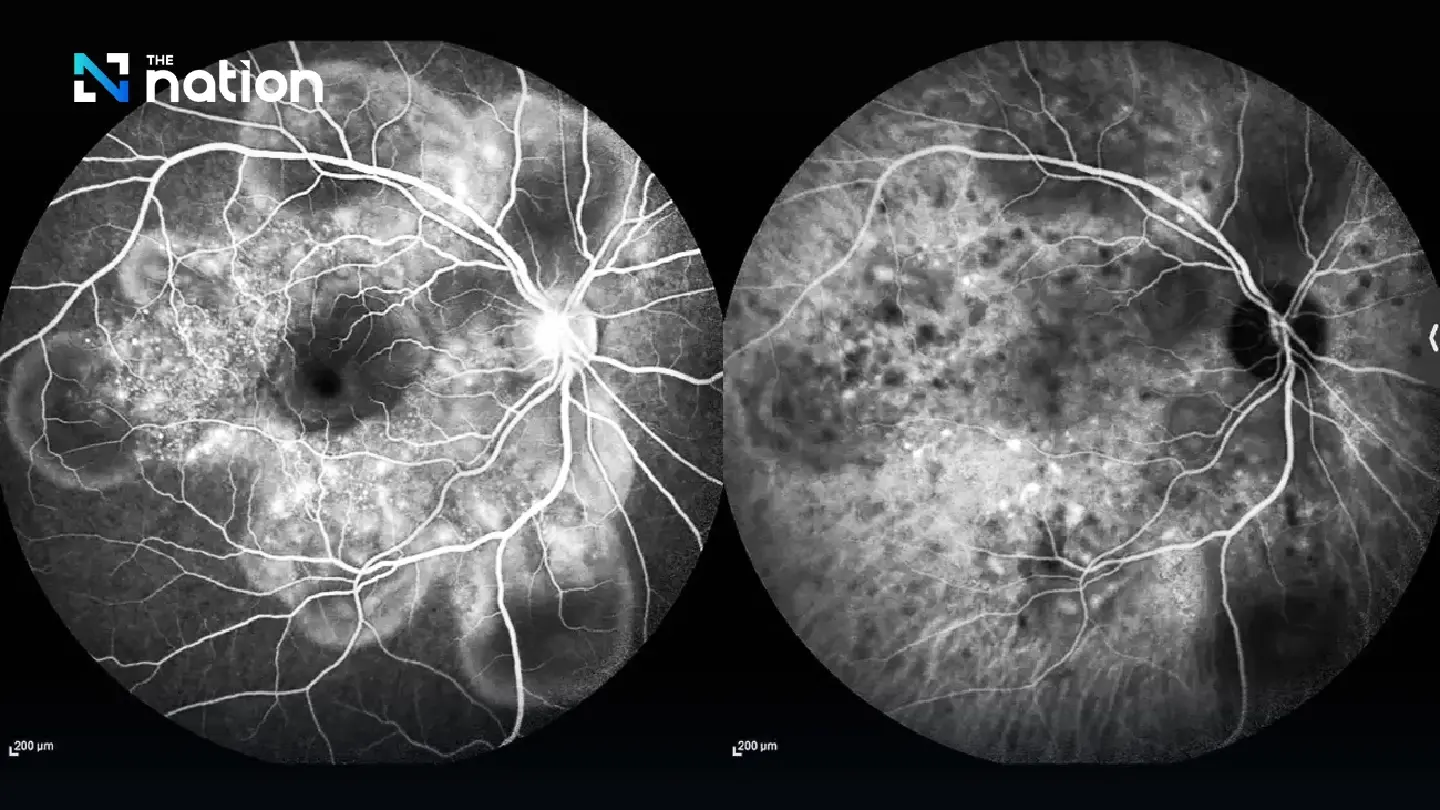 Thailand wins 3 awards at int’l ophthalmic photography contest