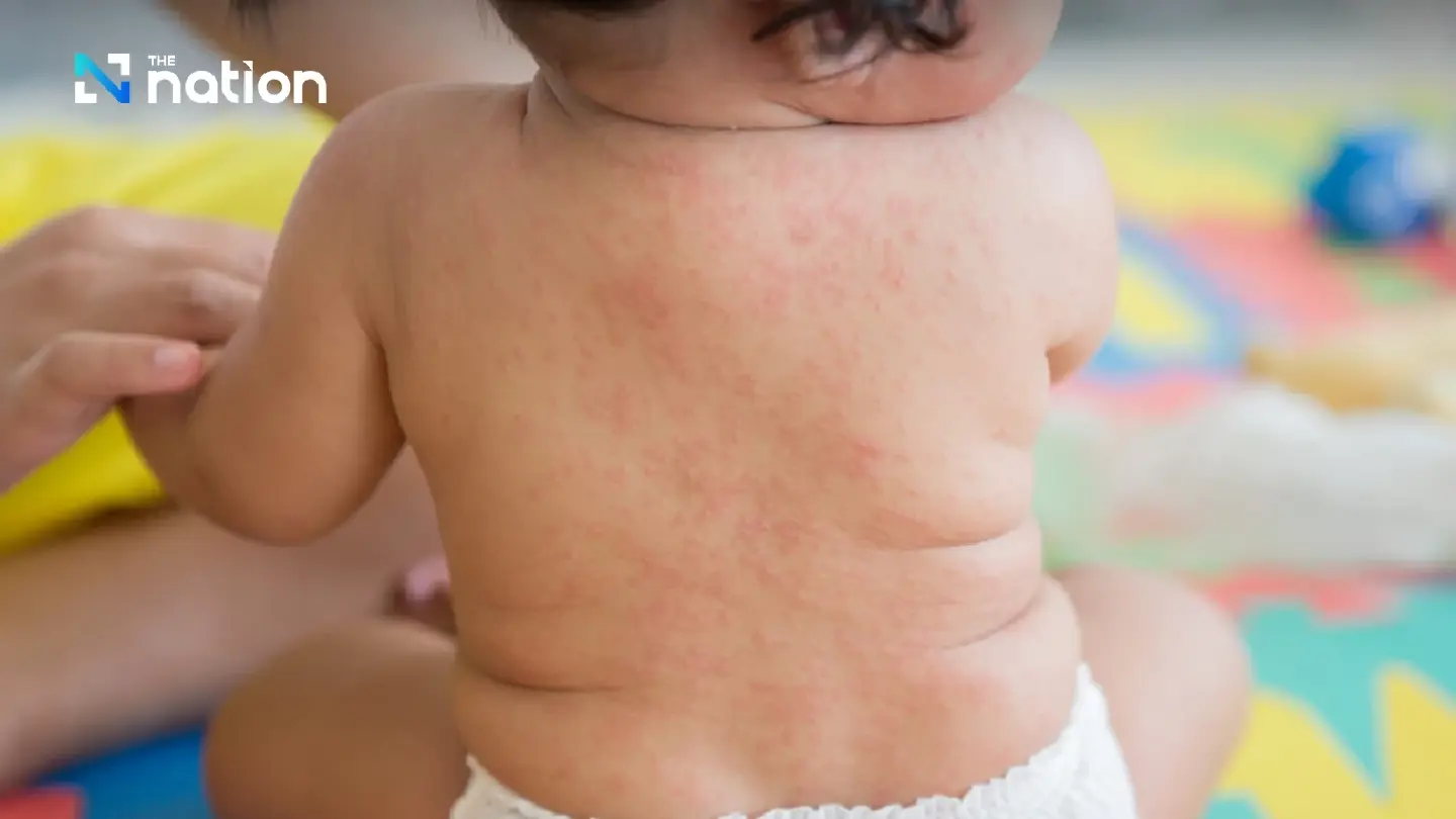 Ministry of Public Health stated that scarlet fever is not new Ministry of Public Health stated that scarlet fever is not new