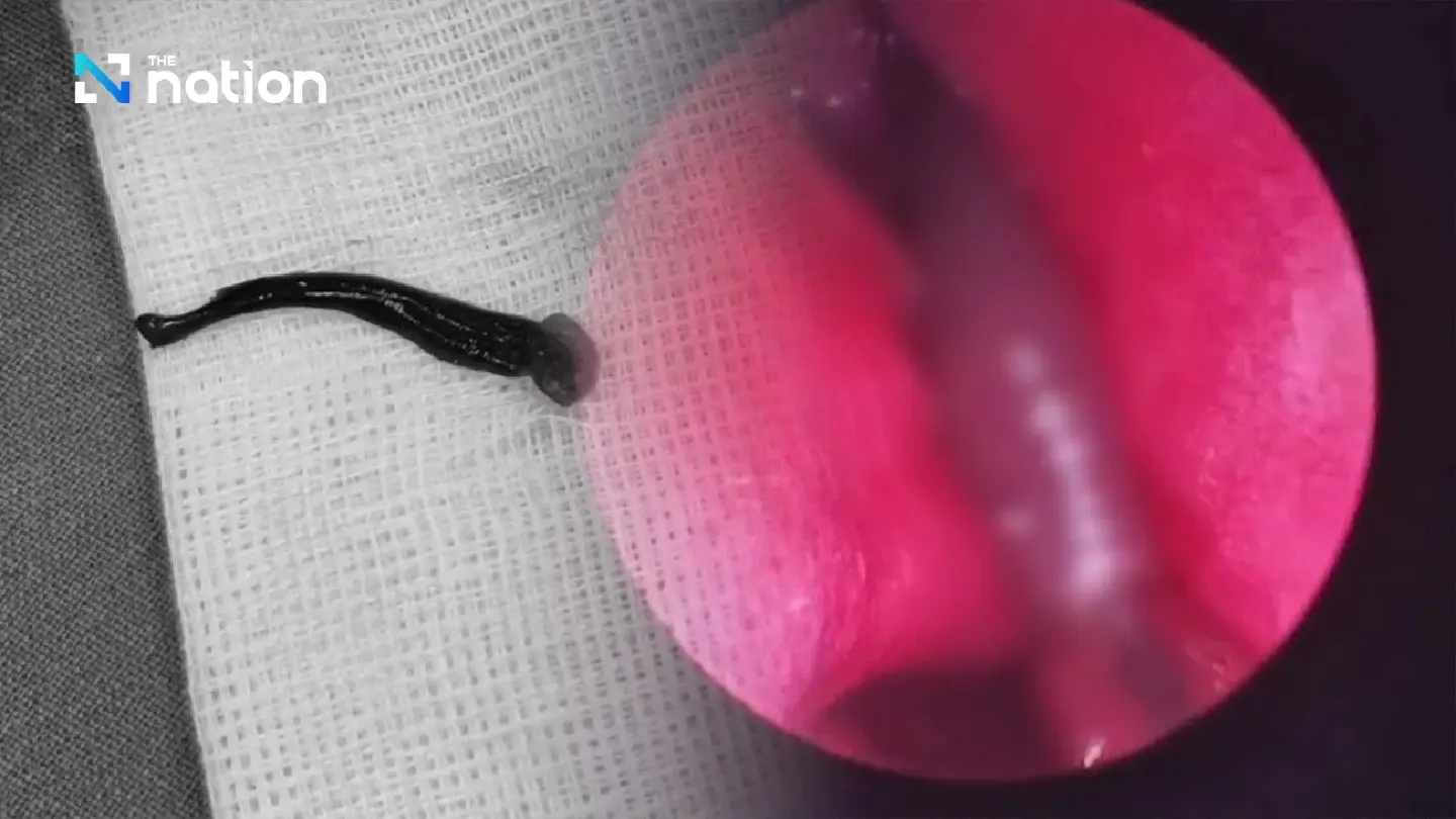 Leech removed from 3-year-old girl’s nostril in Chiang Mai Leech removed from 3-year-old girl’s nostril in Chiang Mai