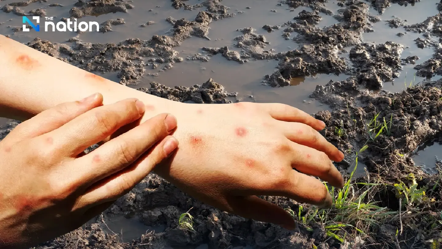 Melioidosis alert: Thai health officials warn high-risk groups amid case spike Melioidosis alert: Thai health officials warn high-risk groups amid case spike