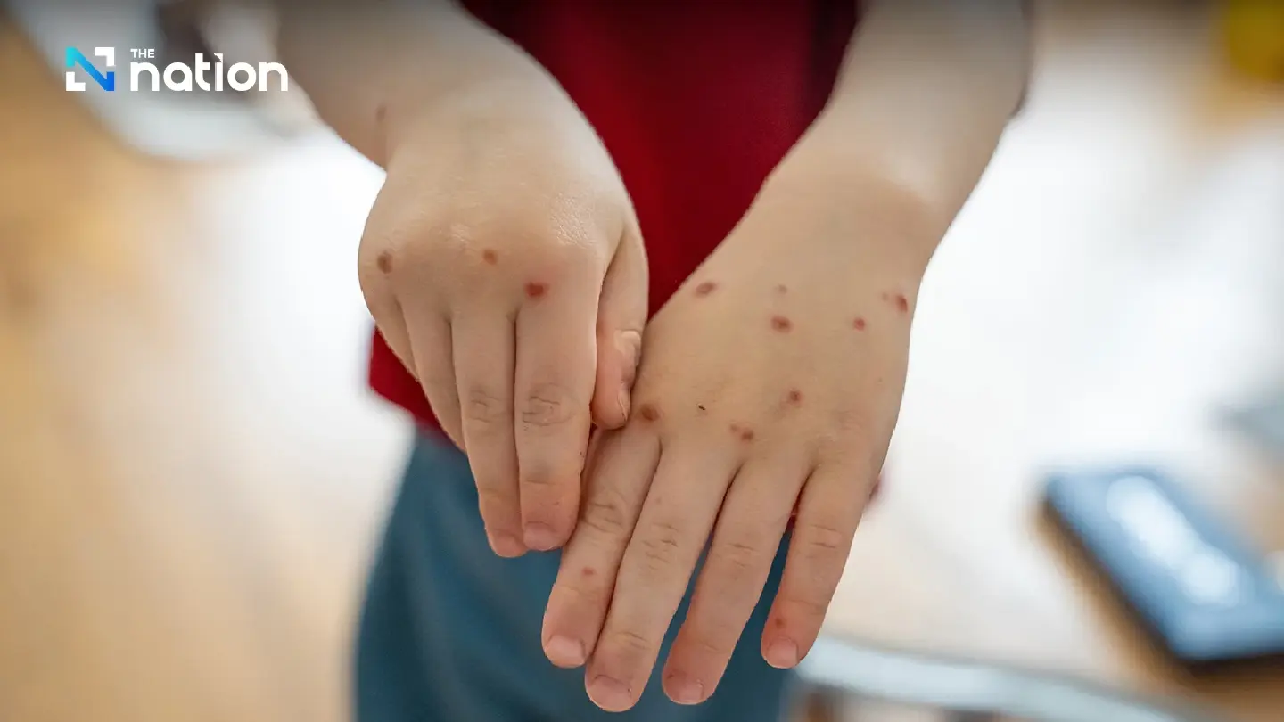 Thailand reports 40 monkeypox cases in 2025, urges high-risk groups to practise safe sex Thailand reports 40 monkeypox cases in 2025, urges high-risk groups to practise safe sex