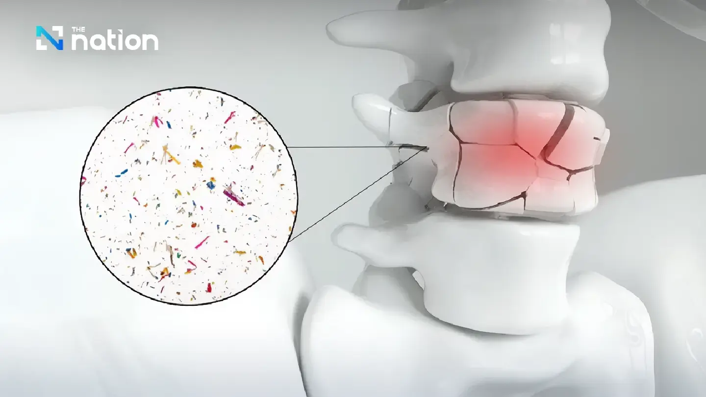Microplastics found in bones, linked to osteoporosis and fractures