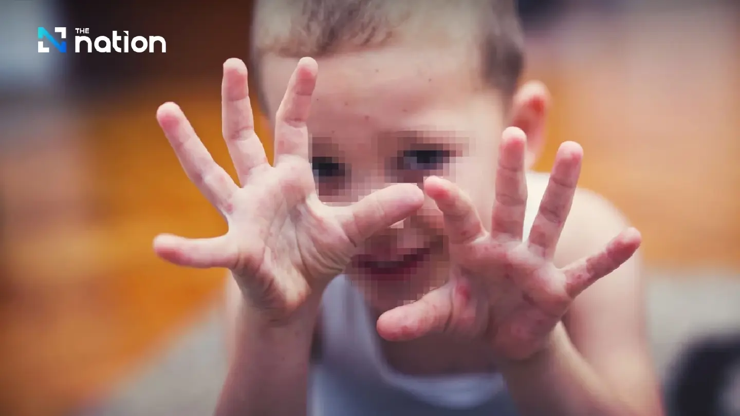 Hand, foot and mouth disease surges in young children, cases up 65.7% in 8 months Hand, foot and mouth disease surges in young children, cases up 65.7% in 8 months