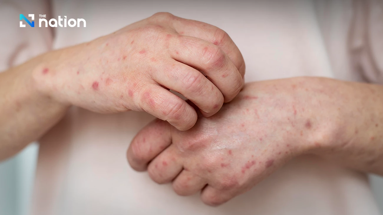 Thailand ramps up Mpox monitoring, especially in key tourist areas