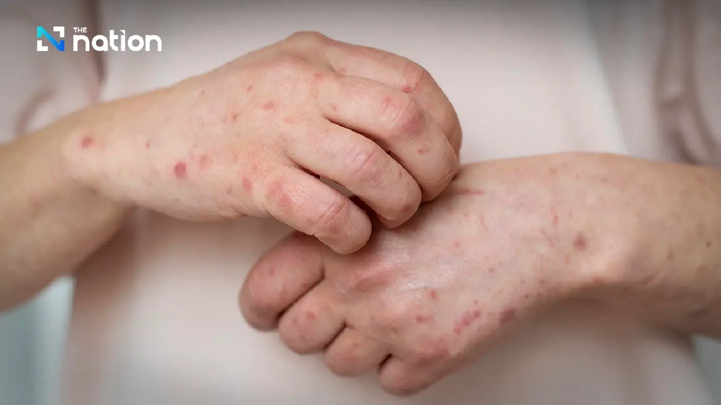 DDC urges vigilance as US measles outbreak grows, warns travellers