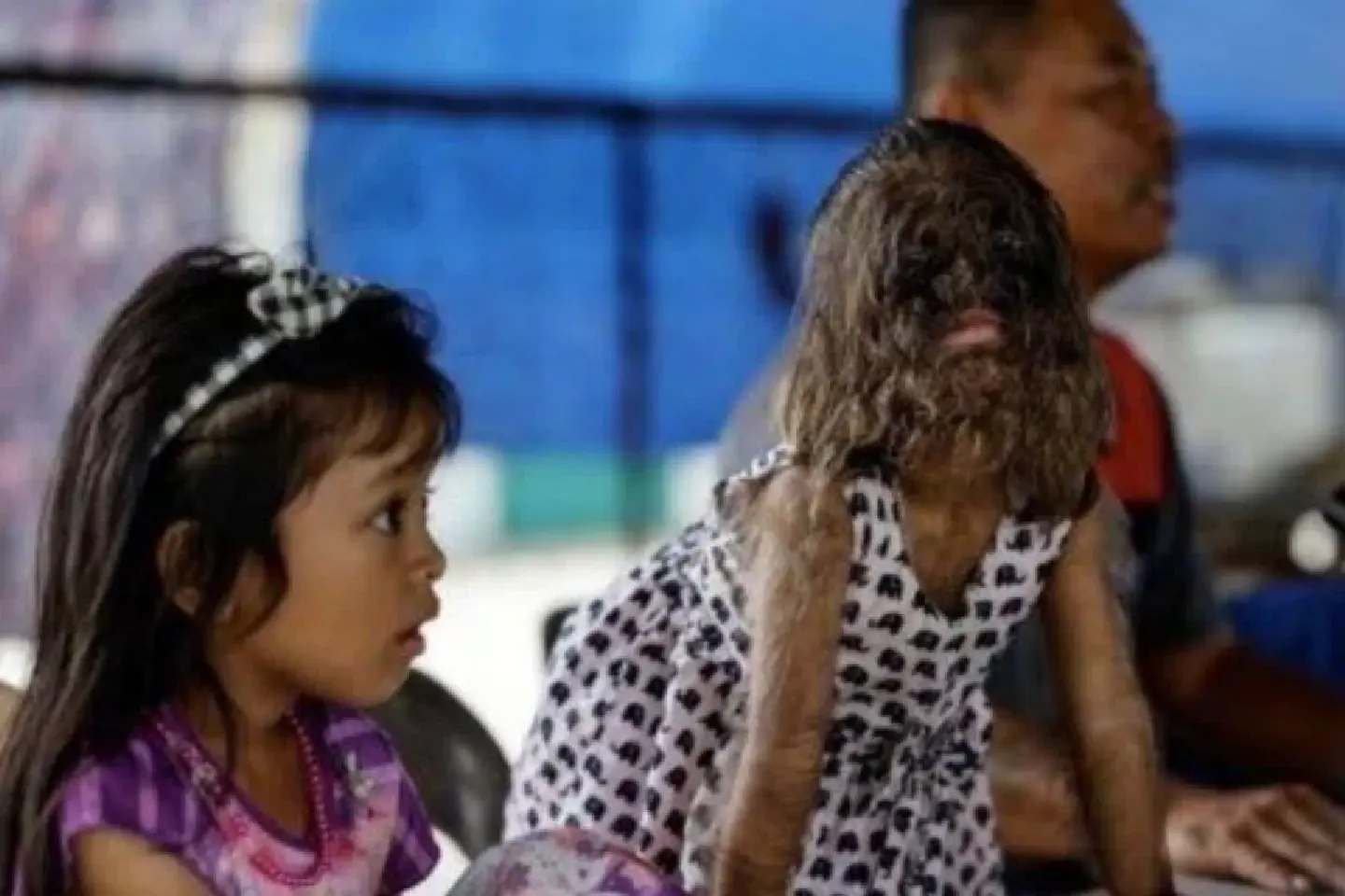 Malaysian girl with werewolf syndrome adjusting to pre-school life Malaysian girl with werewolf syndrome adjusting to pre-school life