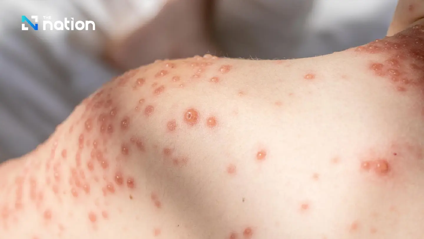 DDC probes chickenpox outbreak at Thammasat Rangsit campus