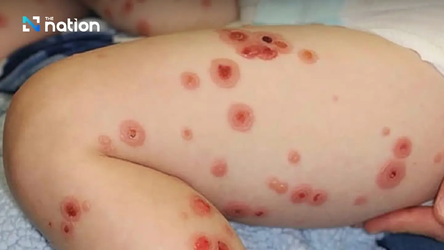 Thailand monitors UK meningitis outbreak, urges vigilance