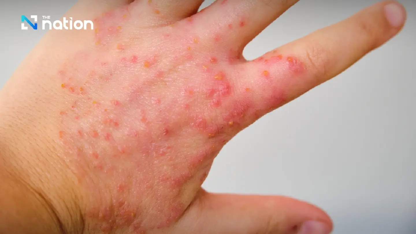 UK meningococcal outbreak raises alarm after two deaths