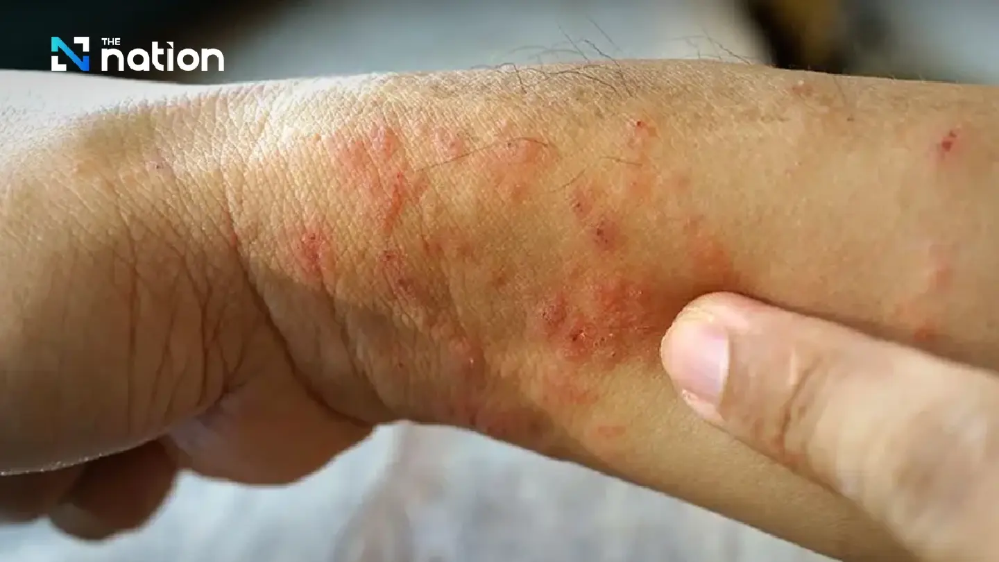 Thai Government Warns of Deadly 'Soil Fever' Outbreak as Fatalities Rise