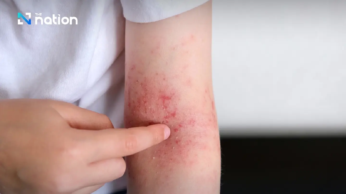 Thailand steps up mpox clade Ib surveillance after two new cases Thailand steps up mpox clade Ib surveillance after two new cases